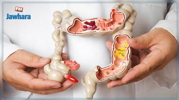 1300 شخص يصابون سنويا بسرطان الأمعاء الغليظة في تونس 