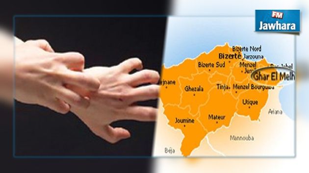Bizerte : Plusieurs cas de gale enregistrés dans une école à Ghar-El-Melh