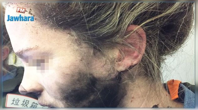 En plein vol : Une Australienne brûlée au visage par l'explosion de ses écouteurs 