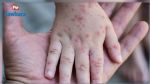La variole du singe diagnostiquée pour la première fois chez des enfants aux États-Unis