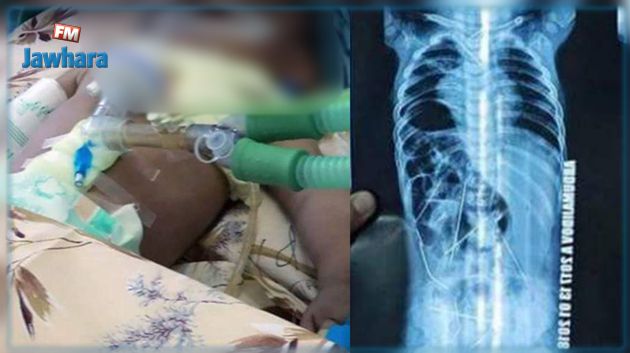 حادثة صادمة.. أطباء يستخرجون 16 إبرة خياطة من جسد رضيع!