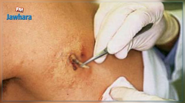 القيروان: الإدارة الجهوية للصحة تنفي تسجيل إصابات بمرض اللاشمانيا