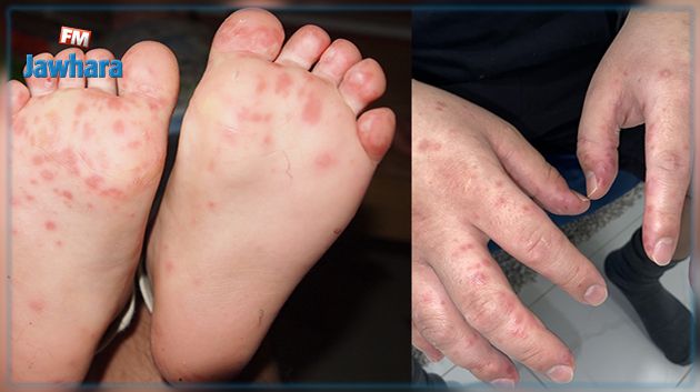 بعد إصابة 40 طفلا بمتلازمة القدم اليد الفم في توزر : الإدارة الجهوية للصحة توضح