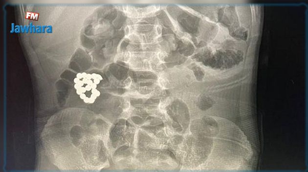 السعودية: فريق طبّي ينجح في استخراج