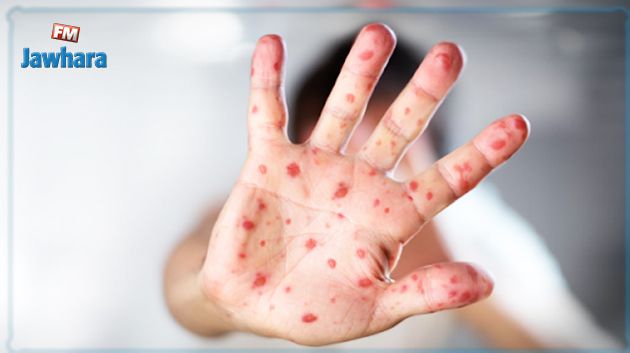 وزارة الصحة تعلن عن حملة وطنية للتلقيح ضد الحصبة