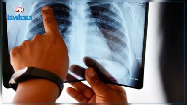 تونس تسجل 22 إصابة جديدة بالسلّ لكل 100 ألف ساكن