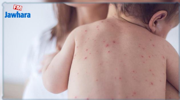 الصحة العالمية تُحذّر من تفشّي مرض الحصبة بين الأطفال