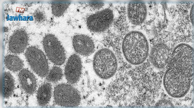 تطمينات من وزارة الصحّة بخصوص جدري القردة