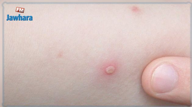 منظمة الصحة تدعو الى تطويق جدري القردة