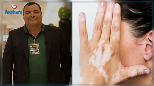 الدكتور محمد الدنقزلي يكشف تفاصيل دواء جديد يعالج البهاق 