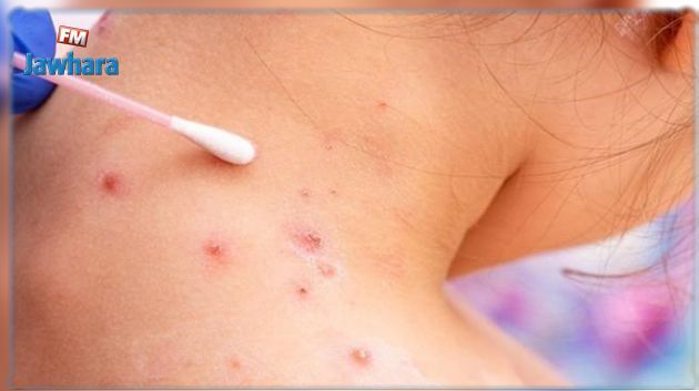 مختص في علم الفيروسات: تونس لازالت في مأمن من 