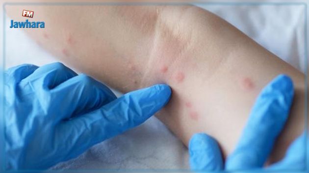 اشتباه في حالة إصابة بجدري القردة بصفاقس: المدير الجهوي للصحة يوضح