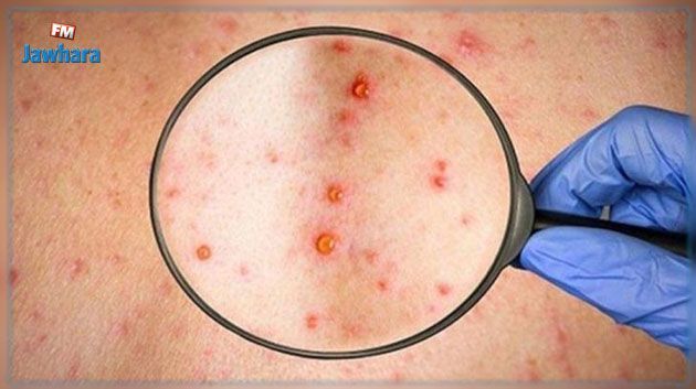 مصر تسجل أول حالة إصابة بجدري القرود