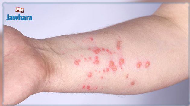 العوني: تونس في مأمن من تفشي جدري القردة