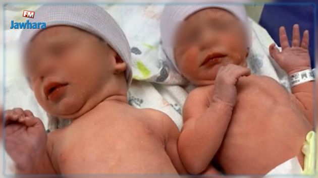 قصة ليديا وتيموثي :حطما رقما قياسيا قبل الولادة