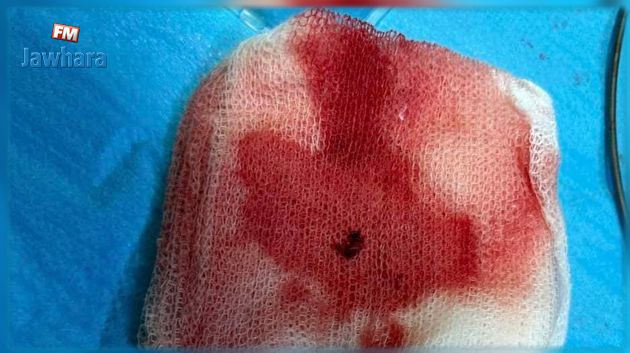 قطعة دم متخثر لا يتجاوز طولها 1 صم كادت أن تُسبب شللا نصفيا لمشجعة تونسية