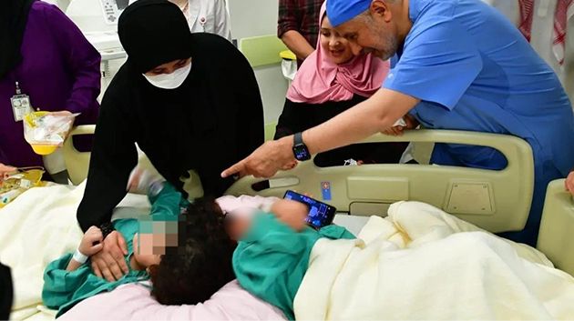 بعد عمليّة دامت 17 ساعة: فصل توأم سيامي مصري بالسعودية