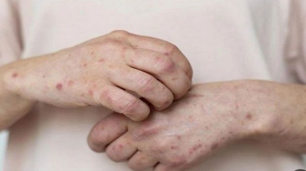 طوارئ بسبب تفشي 'الحصبة' في هذا البلد