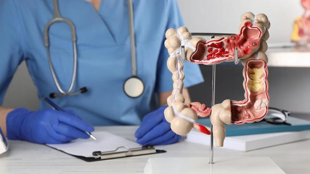 ارتفاع ملحوظ لسرطان القولون في تونس..الأسباب والأعراض