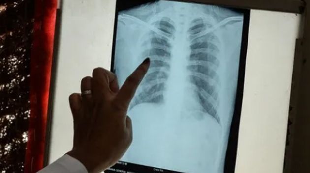 المدير الجهوي للصحة بنابل: 20 إصابة بالسلّ..و لا داعي للقلق