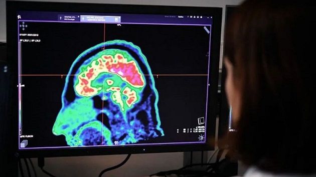 هل يمكن لمخّ البشر تجديد خلاياه؟.. دراسة تحسم الجدل