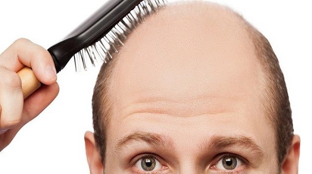 بارقة أمل: دواء جديد يُعالج الصلع