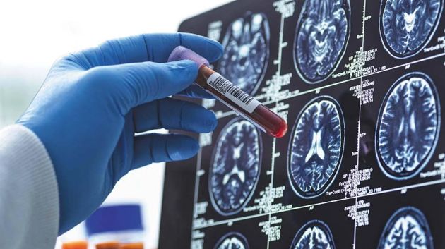 اختبار دم منزلي بسيط لكشف الزهايمر