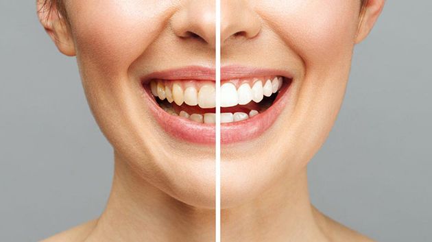 وزارتا الصحة والتجارة: 'تبييض الأسنان خارج العيادات الطبية قد يعرّض سلامتكم للخطر'