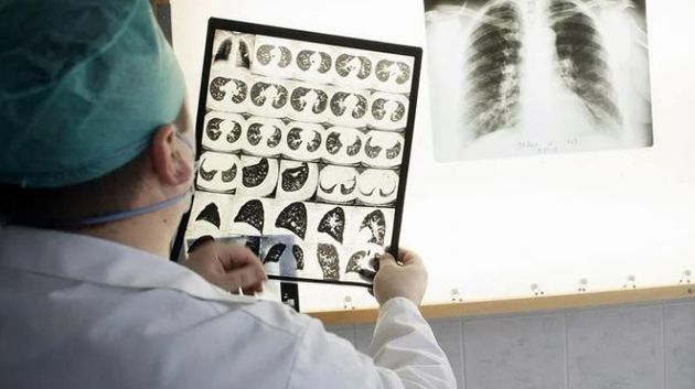 عميد الأطباء البيطريين يؤكد أن القضاء على السل العقدي ممكن