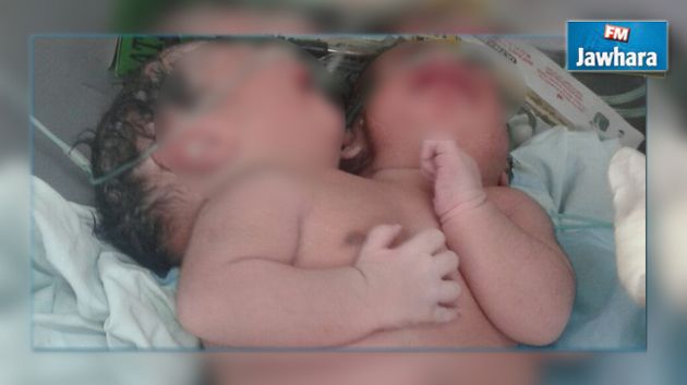مصر : ولادة طفلة برأسين