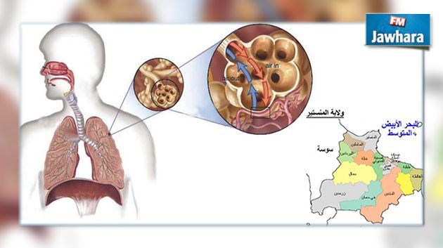 اصابة بمرض السلّ في المنستير : وزارة الصحة توضح