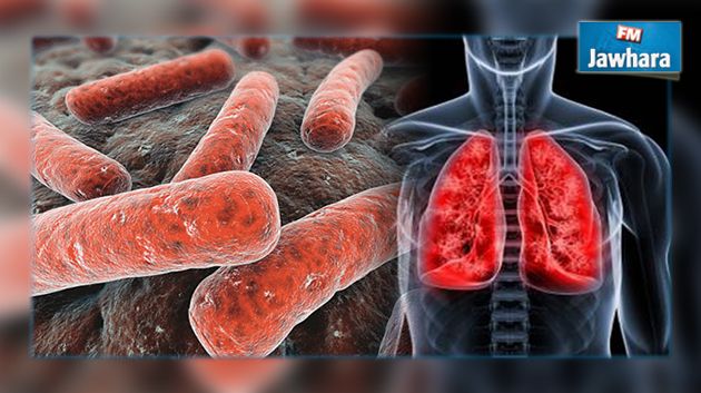 اكتشاف حالة إصابة بمرض السل بالمدرسة العليا للفلاحة بماطر