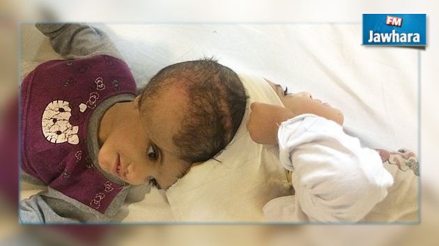 السعودية : إجراء أخطر عملية فصل رأس لسيامي