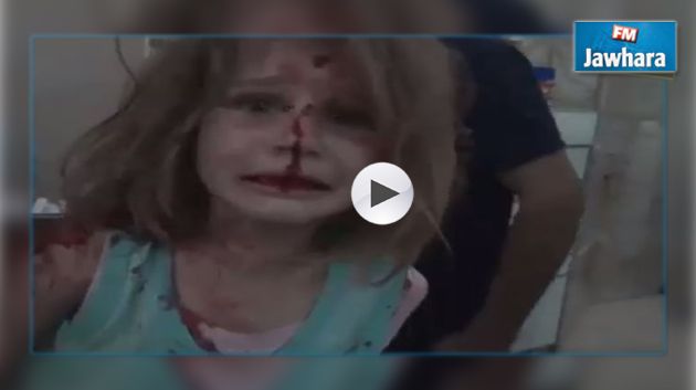 طفلة سورية ضحية القصف تبحث عن والدها رغم الألم