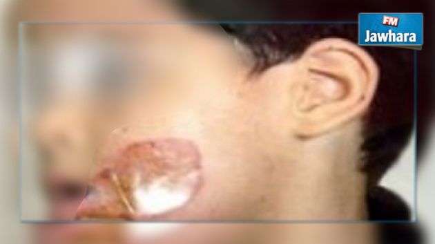 بعد تعرّض طفل للحرق : نقابة رياض الأطفال تطالب بتطبيق القانون