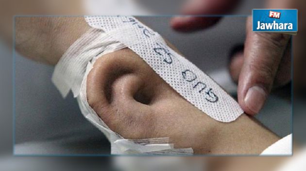 الصين: زراعة أذن في ذراع مريض