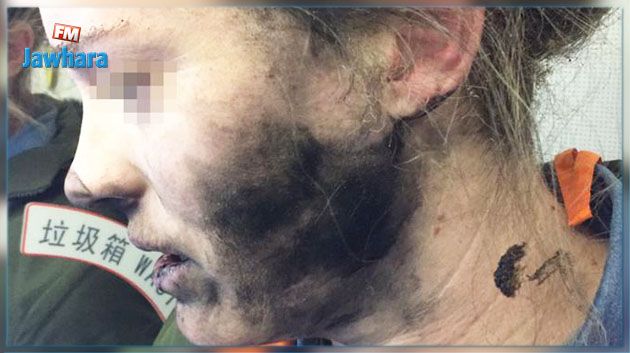 بطارية سماعة تنفجر في وجه مسافرة خلال رحلة جوية