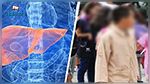 الكشف عن 18 حالة التهاب بالكبد الفيروسي بين صفوف التلاميذ في قفصة 
