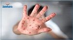 تسجيل 5 حالات إصابة بفيروس جدري القردة في الولايات المتحدة