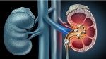 علاج واعد لعلاج حصى الكلى