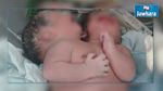 مصر : ولادة طفلة برأسين  