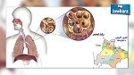 اصابة بمرض السلّ في المنستير : وزارة الصحة توضح