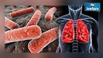 اكتشاف حالة إصابة بمرض السل بالمدرسة العليا للفلاحة بماطر