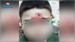 مواطن : ابني أصيب في المدرسة وظل ساعتين ينزف دون اسعافه !