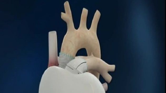 France : Mort du malade ayant bénéficié d'un cœur artificiel