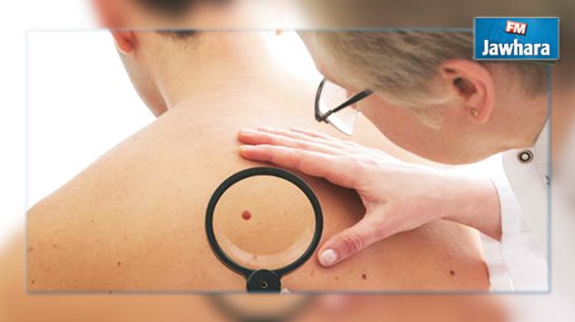 Développement d’une nouvelle molécule contre le cancer de la peau