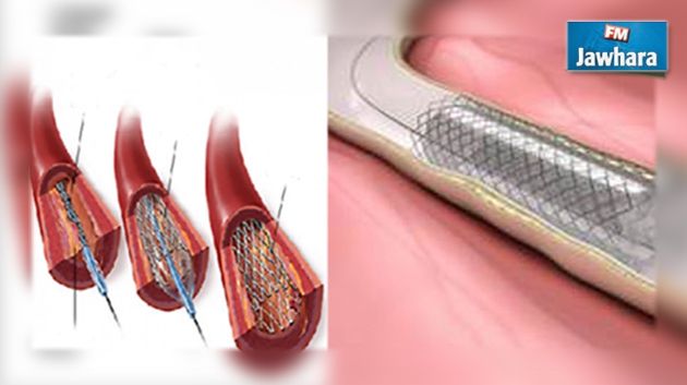 Said Aidi : Le document relatif aux stents périmés a été égaré