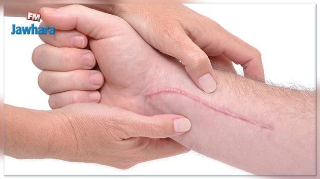 Comment éviter la formation des cicatrices?