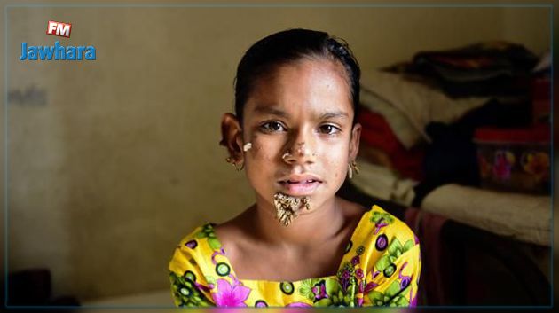 Un possible premier cas mondial de «femme-arbre» détecté à Bangladesh