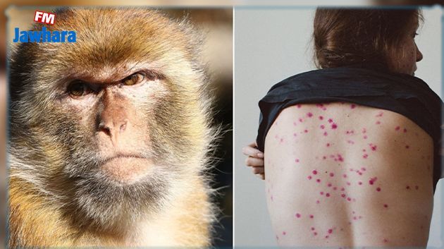 La variole du singe s'étend : Au total, 80 cas sont confirmés et une cinquantaine d'autres sont à l'étude